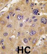 Ab65471 (1:10) staining human ALDH6A1 in human hepatocarcinoma tissue by immunohistochemistry using formalin fixed, paraffin embedded tissue.