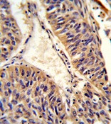 Immunohistochemical analysis of formalin-fixed and paraffin-embedded Human lung carcinoma labeling ALG14 with ab176239 at a 1/50 dilution, followed by peroxidase-conjugation to the secondary antibody and DAB staining.