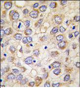 ab75699, at a dilution of 1/10, staining Alkaline Phosphatase in formalin fixed, paraffin embedded human hepatocarcinoma tissue by Immunohistochemistry. ab75699 was peroxidase conjugated to the secondary antibody, followed by DAB staining. 