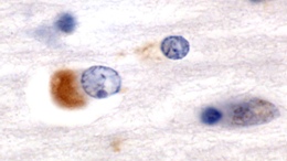 Staining of Lewy body in Dementia with Lewy body disease tissue. Primary antibody ab21975 at 1/1000, secondary antibody biotinylated Donkey and sheep followed by Vector ABC and DAB substrate.