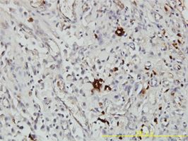 Alpha 1 Acid Glycoprotein antibody (ab58291) used in immunohistochemistry at 1ug/ml on formalin fixed and paraffin embedded human stomach carcinoma tissue.