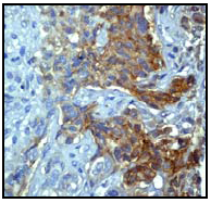 Ab51032 (1:100) staining human alpha 1 Catenin in human breast carcinoma tissue by immunohistochemistry using paraffin embedded tissue.