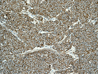 Immunohistochemical analysis of Paraffin Embedded Human breast carcinoma tissue labelling Alpha Fodrin with ab133320 at 1/500 dilution.