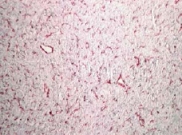 Human Leiomyoma stained with ab5694.
