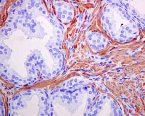 Immunohistochemistry (Formalin/PFA-fixed paraffin-embedded sections) analysis of human prostatic carcinoma smooth muscles tissue labelling alpha smooth muscle Actin with unpurified ab124964.