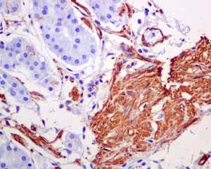 Immunohistochemistry (Formalin/PFA-fixed paraffin-embedded sections) analysis of human stomach carcinoma smooth muscles tissue labelling alpha smooth muscle Actin with unpurified ab124964.