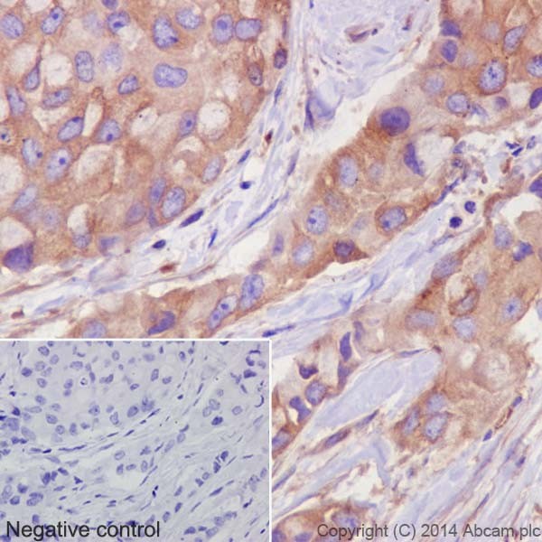 Immunohistochemistry analysis of paraffin-embedded Human breast cancer labeling alpha Tubulin with ab52866 at a 1/1000 dilution. Cytoplasmic staining on cancer cells shown. Secondary antibody ab97051 Goat Anti-Rabbit IgG H&L (HRP) used at a 1/500 dilution. Counter stained with Hematoxylin.Inset image: negative control obtained using PBS instead of ab52866, secondary antibody is Anti-Rabbit HRP (ab97051) at 1/500 dilution.