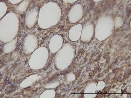 Aminoacylase 1 antibody (ab54960) used in immunohistochemistry at 3ug/ml on formalin fixed and paraffin embedded human malignant lymphoma, diffuse large B tissue.