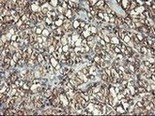 ab119839, at 1/150, staining Aminopeptidase A in paraffin embedded Human kidney carcinoma tissue by Immunohistochemistry.