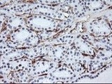 ab119839, at 1/150, staining Aminopeptidase A in paraffin embedded Human thyroid carcinoma tissue by Immunohistochemistry.