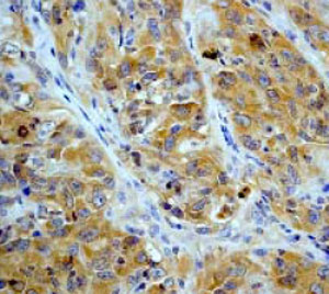 ab32112 at a 1:100 dilution staining AMPK beta 1 in human lung carcinoma, using Immunohistochemistry, Paraffin Embedded Tissue.