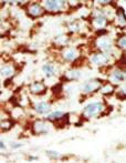 Formalin-fixed, paraffin-embedded human hepatocarcinoma tissue reacted with ab70922 at a 1:50 dilution, which was peroxidase-conjugated to the secondary antibody, followed by AEC staining.