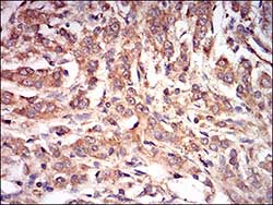 Immunohistochemical analysis of paraffin-embedded Human prostate cancer tissue labeling AMPK gamma 1 with ab181460 at 1/200 dilution, with DAB staining.