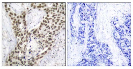 ab47562, at 1/50 dilution, staining Androgen Receptor in Human prostate carcinoma by Immunohistochemistry, paraffin-embedded tissue. Left panel: no peptide; right panel: blocking phosphopeptide.