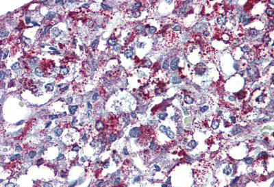 Immunohistochemical analysis of formalin-fixed, paraffin-embedded Human adrenal tissue labelling Angiotensin II Type 2 Receptor with ab140704 after heat-induced antigen retrieval. After incubation with the primary antibody, slides were incubated with biotinylated secondary antibody, followed by alkaline phosphatase-streptavidin and chromogen.