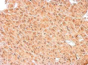 Immunohistochemical analysis of Paraffin-embedded Human U87 xenograft tissue, labeling Anillin with ab154337 at 1/500 dilution.