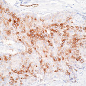 Formalin-fixed, paraffin-embedded human breast carcinoma stained with ab80582 at 8µg/ml using a peroxidase-conjugate and DAB chromogen. Note cell membrane with some cytoplasmic staining of tumor cells.