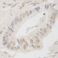 ab99400, at 1/250 dilution, staining ANKRD28 in formalin-fixed, paraffin-embedded Human stomach carcinoma by Immunohistochemistry. Detection: DAB staining.