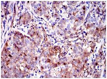 Immunohistochemical analysis of paraffin-embedded Human cervical cancer tissue labelling Annexin A1 with ab135256 at 1/200 dilution followed by DAB staining.