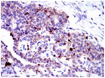 Immunohistochemical analysis of paraffin-embedded Human ovarian cancer tissue labelling Annexin A1 with ab135256 at 1/200 dilution followed by DAB staining.