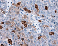ab118060 at 1/50 dilution staining Annexin A1 in Paraffin-embedded Human Ovary adenocarcinoma tissue by Immunohistochemistry.