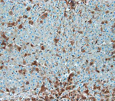 IHC image of Antithrombin III staining in Human normal liver formalin fixed paraffin embedded tissue section, performed on a Leica Bond™ system using the standard protocol F. The section was pre-treated using heat mediated antigen retrieval with sodium citrate buffer (pH6, epitope retrieval solution 1) for 20 mins. The section was then incubated with ab20933, 5µg/ml, for 15 mins at room temperature and detected using an HRP conjugated compact polymer system. DAB was used as the chromogen. The section was then counterstained with haematoxylin and mounted with DPX. For other IHC staining systems (automated and non-automated) customers should optimize variable parameters such as antigen retrieval conditions, primary antibody concentration and antibody incubation times.