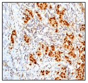 ab76007, at 1/250 dilution, staining AP2 gamma in human breast carcinoma by immunohistochemistry using paraffin-embedded tissue.