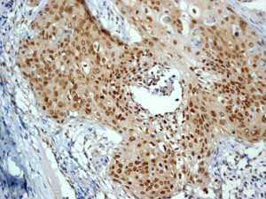 ab76007 showing positive staining in Cervical carcinoma tissue.
