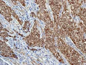 ab76007 showing positive staining in Endometrial carcinoma tissue.