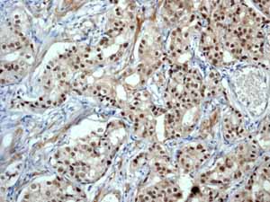 ab76007 showing positive staining in Prostatic carcinoma tissue.