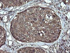 Immunohistochemical analysis of paraffin-embedded Human lung carcinoma tissue labelling Apc11 with ab140511 at 1/150 dilution.