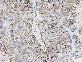 ab123855, at 1/150 dilution, staining Apc2 in paraffin-embedded adenocarcinoma of Human breast tissue by Immunohistochemistry.