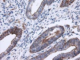 ab123855, at 1/150 dilution, staining Apc2 in paraffin-embedded adenocarcinoma of Human endometrium tissue by Immunohistochemistry.