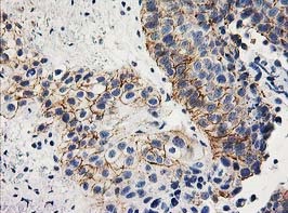 ab123855, at 1/150 dilution, staining Apc2 in paraffin-embedded carcinoma of Human bladder tissue by Immunohistochemistry.