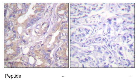 ab59343, at a 1/50-1/100 dilution, staining human A RAF in breast carcinoma with (+) or without (-) immunising peptide), using Immunohistochemistry, Paraffin embedded tissue
