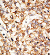 Staining of APOBEC1 on formalin-fixed and paraffin-embedded human hepatocarcinoma tissue with ab38601, detected using a peroxidase-conjugated secondary antibody, followed by AEC staining.