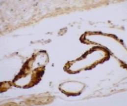 IHC-P using ab1906. Strong immunoreactivity to Apo E of vascular amyloid ß. Down syndrome. Orig. magn. X 100.