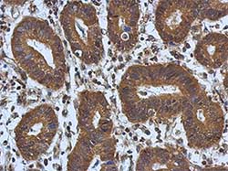 Immunohistochemical analysis of paraffin-embedded Human colon carcinoma tissue labelling Apoptosis repressor with CARD with ab137816 at 1/500 dilution