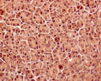 Immunohistochemical analysis of paraffin-embedded Human pancreas carcinoma tissue labeling APPL with ab180140 at 1/100 dilution. Secondary antibody Goat anti rabbit IgG(HRP) prediluted. Counter stain Hematoxylin.