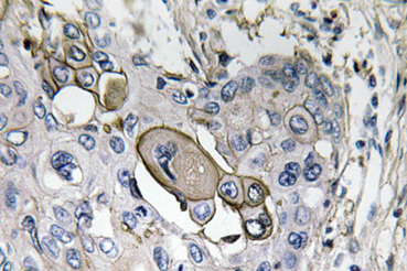 Immunohistochemical analysis of paraffin-embedded Human lung carcinoma tissue labelling Aquaporin 5 with ab134687 at 1/50 dilution.