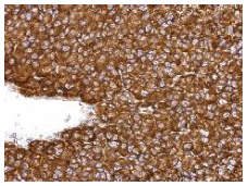 Immunohistochemical analysis of paraffin-embedded Human PC13 xenograft tissue labeling ARD1A with ab155687 at 1/500 dilution.