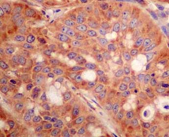 Immunohistochemical analysis of paraffin-embedded Human gastric carcinoma tissue labeling ARFIP2 with ab180503 at 1/500 dilution, followed by ImmunoHistoprobe (Ready to use) HRP Polymer for Rabbit IgG. Counter stained with Hematoxylin.