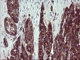 Immunohistochemical analysis of paraffin-embedded Human colon adenocarcinoma tissue labeling Arg2 with ab170159 at 1/150 dilution.
