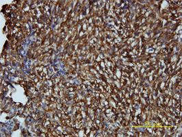ARH antibody (ab57261) used in immunohistochemistry at 2ug/ml on formalin fixed and paraffin embedded human maligant fibrous histiocytoma tissue.