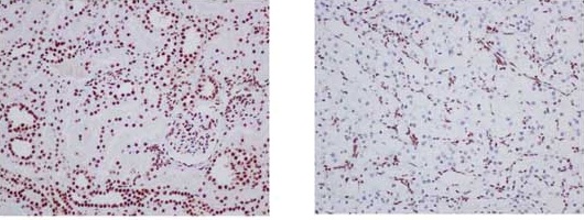 Immunohistochemical analysis of paraffin embedded Human kidney tissue (Left image) labeling ARID1A using ab182560 at 1/1000 dilution. Right image: Right picture: paraffine embedded human clear cell carcinoma of kidney with ARID1A mutation. A Ready to use HRP Polymer for Rabbit IgG (prediluted) was used as secondary. Counterstain: Hematoxylin.
