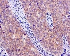 Immunohistochemical analysis of paraffin embedded Human cervical carcinoma tissue labeling Artemin with ab178434 at 1/50.