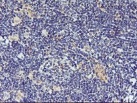ab119763, at 1/150 dilution, staining DPP9 in paraffin-embedded Human lymphoma tissue by Immunohistochemistry.