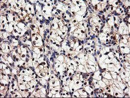 ab119808 at 1/150 dilution staining DPP9 in Paraffin-embedded Human Kidney carcinoma tissue by Immunohistochemistry.