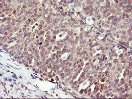 ab119808 at 1/150 dilution staining DPP9 in Paraffin-embedded Human Ovary adenocarcinoma tissue by Immunohistochemistry.