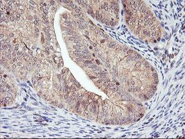 ab119808 at 1/150 dilution staining DPP9 in Paraffin-embedded Human Endometrium adenocarcinoma tissue by Immunohistochemistry.